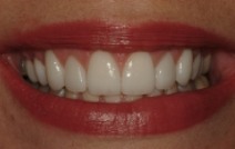 Gorgeous smile after cosmetic dentistry