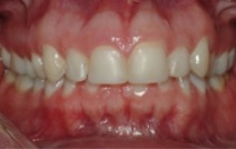 Short stubby top teeth before treatment