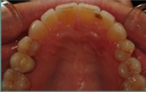 Inside of bottom teeth after dental restoration