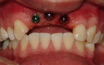 Missing bottom teeth with dental implant posts visible