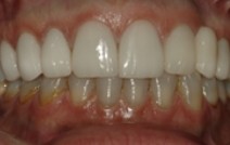 Healthy white smile after front top teeth are repaired