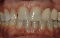 Discolored top front teeth