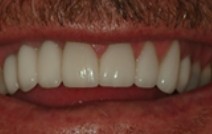 Row after top teeth are replaced