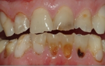 Severely decayed and broken top and bottom teeth