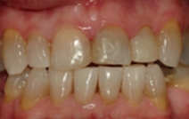 Damaged and discolored top tooth