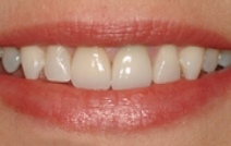 Beautiful smile after dental restoration is replaced