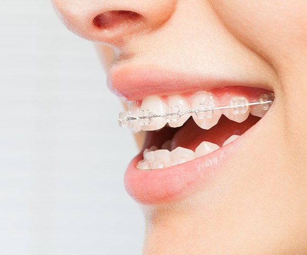 Closeup of smile with six month smiles clear braces